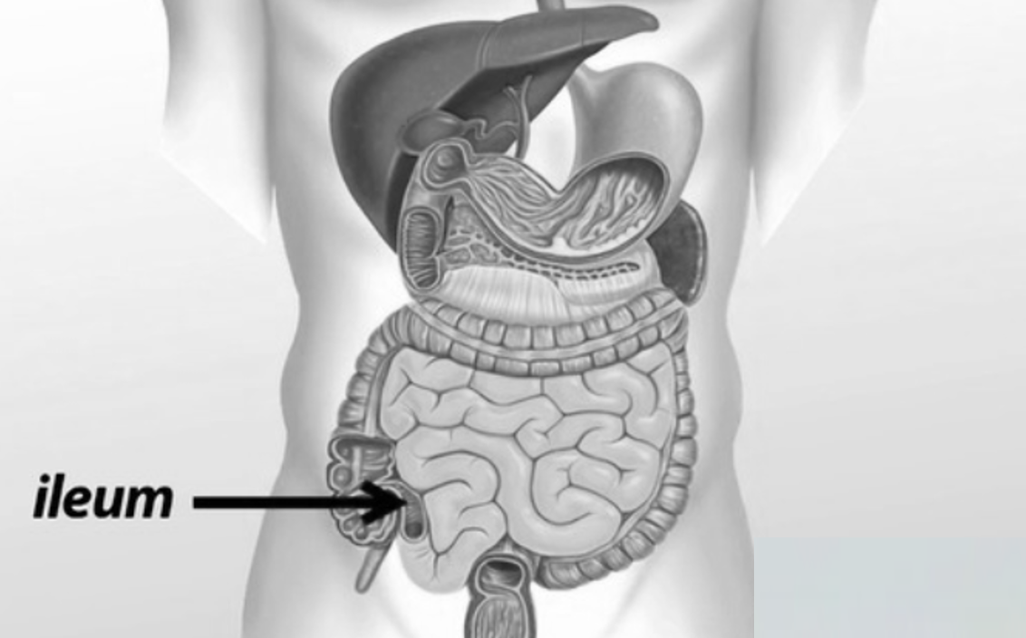 Also…Crohn’s Disease